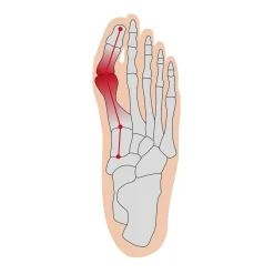 Die moderne Hausfrau Überbein-Schutz, 2 Paar