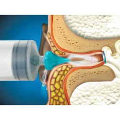 Die moderne Hausfrau Ohrenwachs-Entfernungsspritze